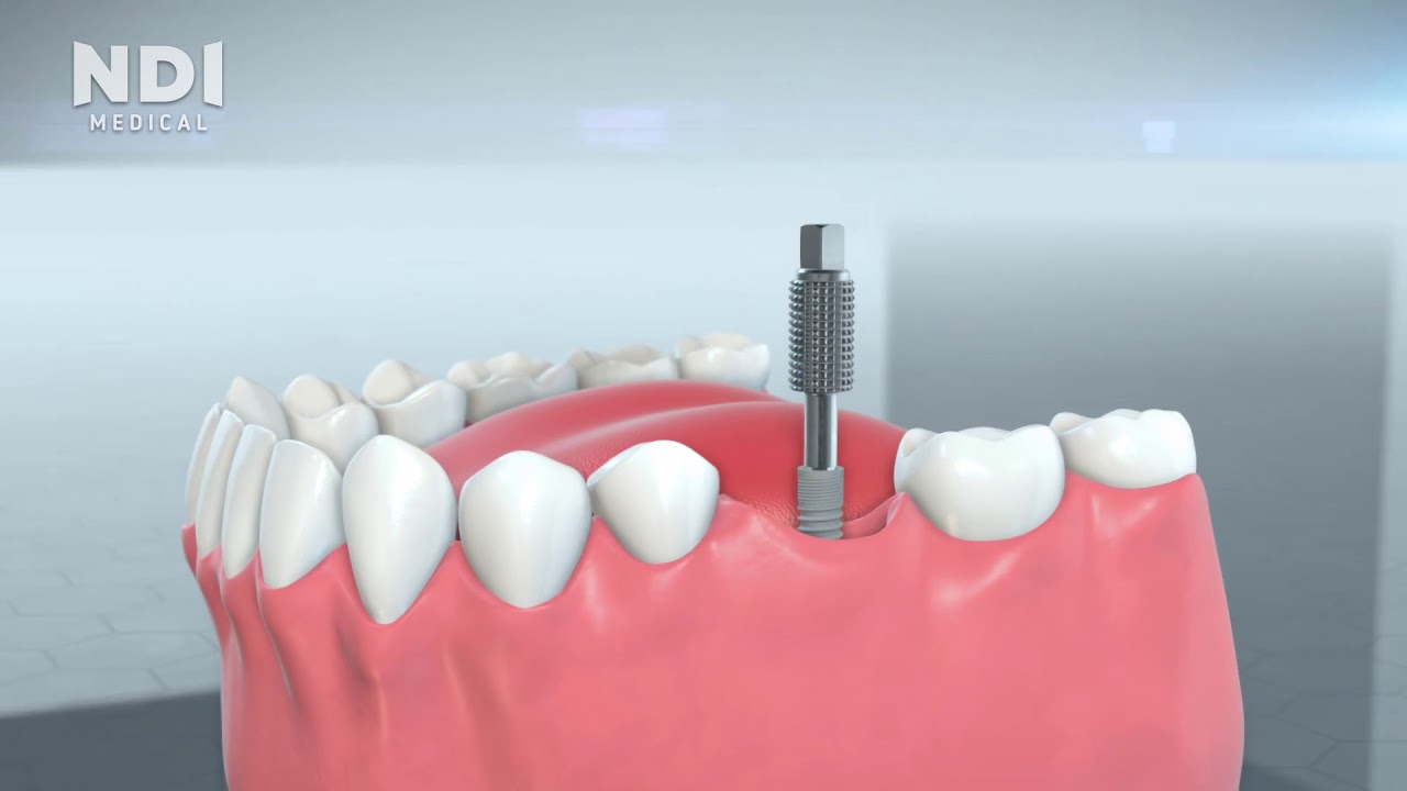 dental implants companies